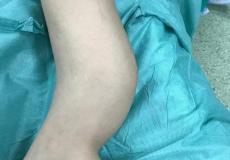 طاقم طبي مجمع ناصر يجري أول عملية جراحية بتقنية "ماسكيليه" لطفل