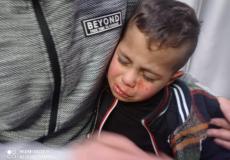 مستوطنون يصيبون طفلا فلسطينيا في وجهه