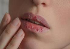 5 علاجات طبيعية لتشقق الفم