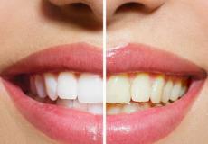 طرق علاج اصفرار الأسنان