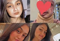 الأميرة مريم التي أحرق شاب وجهها بمادة التيزاب بالعراق