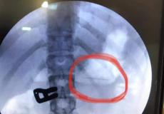استخراج دبوس بطول 2سم بالمنظار من معدة فتاة