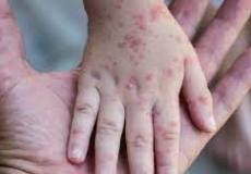 تسجيل 11 إصابة جديدة بجدري القرود في إنجلترا