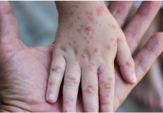 مرض جدري القرود