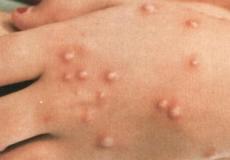 جدري القرود في ايران