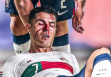 رونالدو يتعرض لإصابة قوية في وجهه