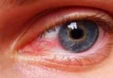 مؤشرات احمرار العين وكيف يمكن علاجها