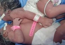 التوأم السيامي أمينة وإيمان