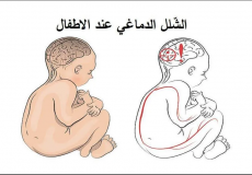 الشلل الدماغي عند الاطفال