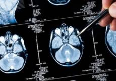 الصيام المتقطع يساعد مرضى الزهايمر على النوم