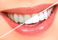 طرق تبييض الأسنان الحساسة في المنزل بخلطات سهلة