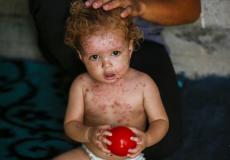 أوبئة جلدية غريبة تضرب النازحين في غزة