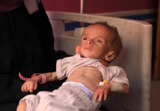 طفل يعاني من سوء التغذية والمجاعة في غزة