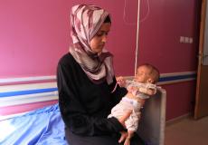 أطفال يعانون من سوء التغذية في غزة