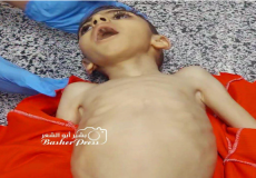 "الموت جوعًا" حين يسبق الجوع القذائف في غزة