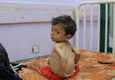 أطفال غزة يعانوا من سوء التغذية