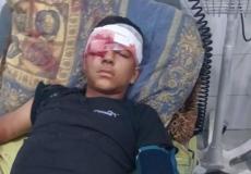 إصابة طفل بجروح خطيرة خلال اقتحام الاحتلال بيت عوا