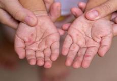 الزراعة تحذر من سلالة "غير مسبوقة" للحمى القلاعية