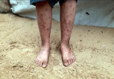 غزة - 17 ألف حالة إصابة مرتبطة بالقوارض