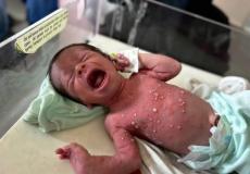 الأمراض الجلدية في غزة تنهش أجساد النازحين تحت حرّ الخيام