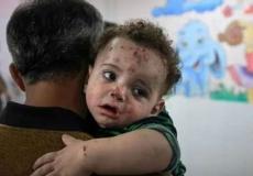 تحذيرات من اتساع رقعة "جدري الماء" في قطاع غزة