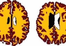 تقل المادة البيضاء مع تقدم السن