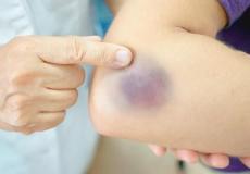 طرق سريعة جدا لعلاج الكدمات