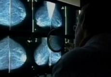 سرطان الرئة الأكثر فتكا بين الرجال والثدي بين النساء في إسرائيل