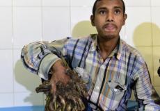 مرض جلدي وراثي نادر للغاية يجعل المريض عرضة لأورام الجلد