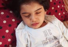 الطفلة ميرا علاء عبد الله الفجم تعاني من ورم سرطاني في العين اليمنى