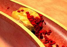 علاج طبيعي يخفض ضغط الدم والكولسترول دون اللجوء إلى حبوب