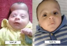 قبل وبعد العملية