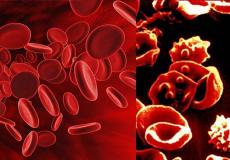  الثلاسيميا