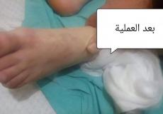 طاقم طبى بمستشفى الاندونيسى ينقذ جريح ثلاثينى من بتر ساقه