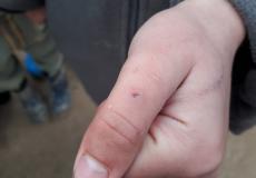 معاناة جديدة تضاف لواقع أهالي مخيم أعزاز