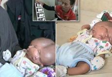 في حادثة نادرة، ولد طفل ذو وجهين، ودماغين في رأس واحد في إندونيسيا.