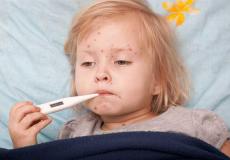 مرض الحصبة عند الاطفال