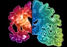 تلف الأنسجة في دماغ مصابة بالخرف مقارنة بأخرى سليمة