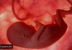 عملية استئصال جنين