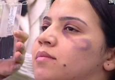 هدف برنامج صباحيات تعليم المرأة كيف تخفي الكدمات باستخدام الماكياج