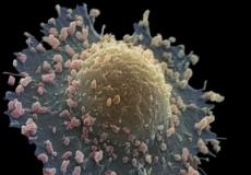 تتجول الخلايا السرطانية التي تصيب الرئتين في الجسم بعد انهيار سطحها الخارجي