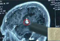 دودة حية تسكن رأسه منذ 17 عاماً 