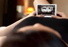 توأم متطابق يتلاكم ويضرب أحدهم الآخر في رحم أمّهما