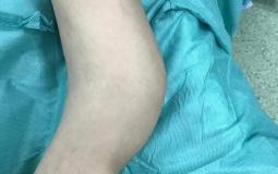 طاقم طبي مجمع ناصر يجري أول عملية جراحية بتقنية "ماسكيليه" لطفل