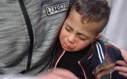 مستوطنون يصيبون طفلا فلسطينيا في وجهه