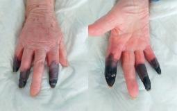 أصابع امرأة مسنة في إيطاليا