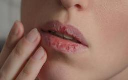5 علاجات طبيعية لتشقق الفم