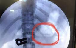 استخراج دبوس بطول 2سم بالمنظار من معدة فتاة
