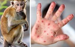 الكشف عن أول إصابة بجدري القردة بالصين 