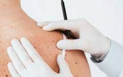 3 ملايين إصابة جديدة بسرطان الجلد غير الميلانيني في كل عام